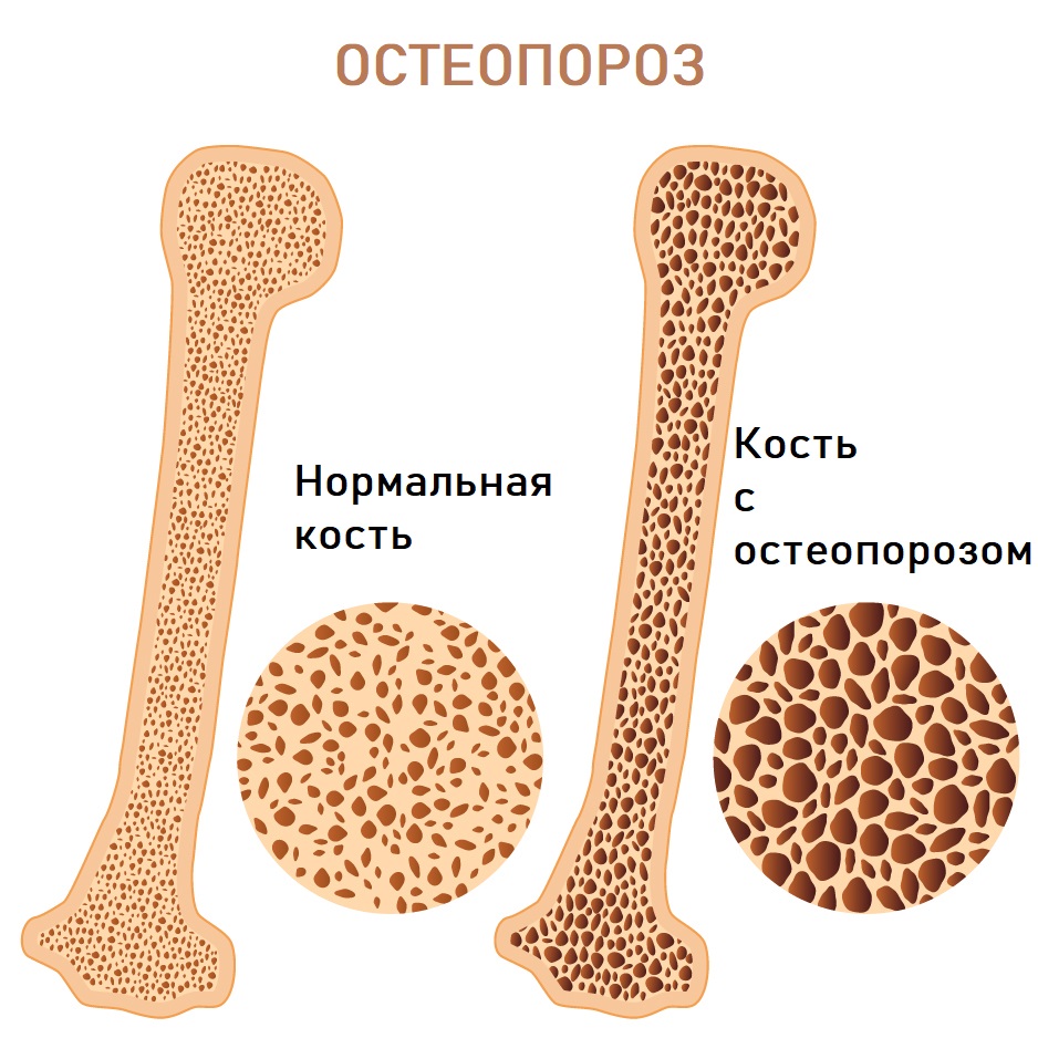 Остеопороз