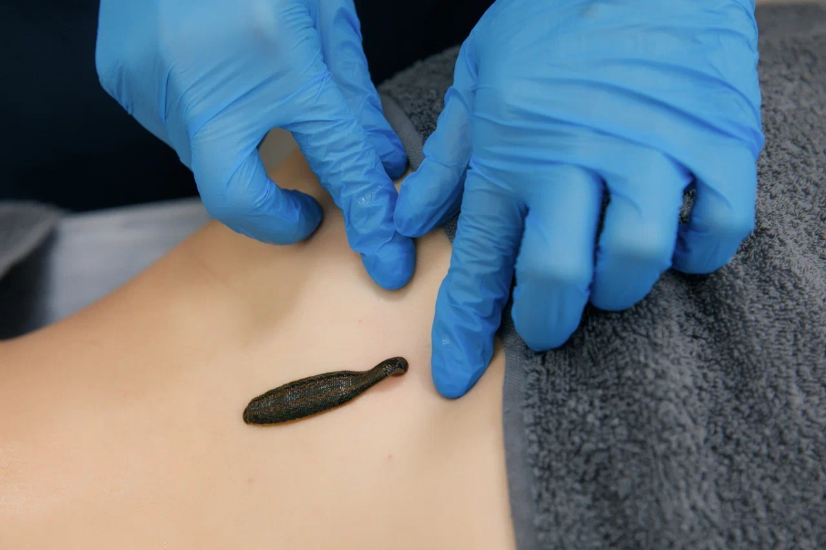 Гирудотерапия в санатории «Веста»