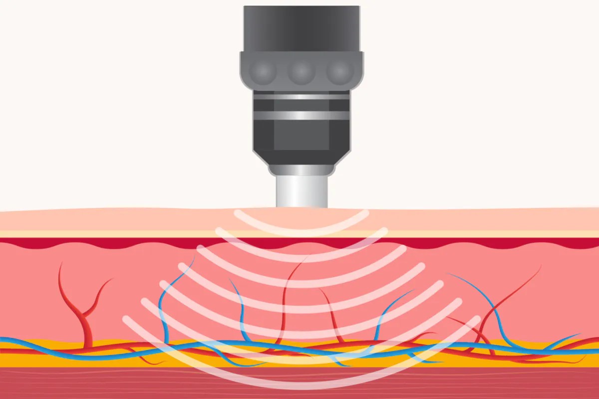 Ударно-волновая терапия